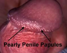Pearly penile papules