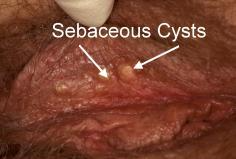 Sebaceous Cysts