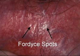 Fordyce Spots