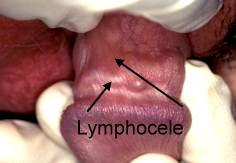 Lymphocele
